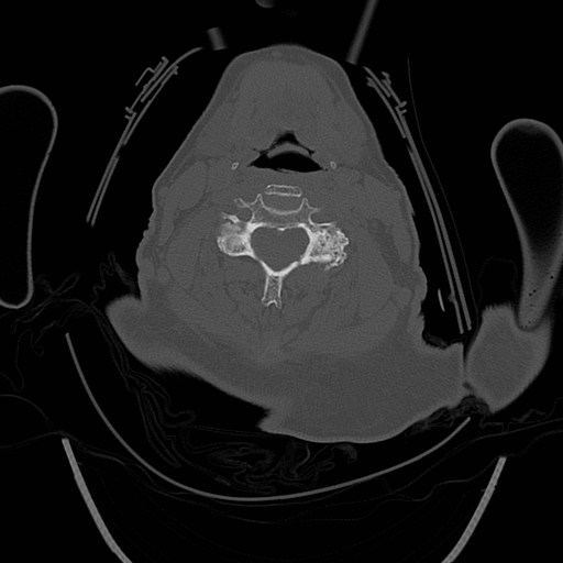 C1 and C2 (peg) fractures (Radiopaedia 36618-38184 Axial bone window 118).jpg