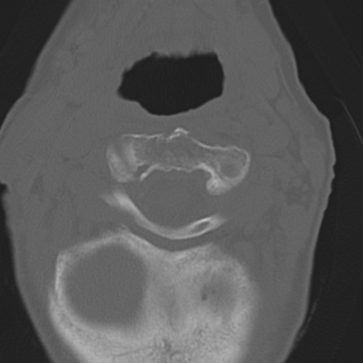 C2 fracture with vertebral artery dissection (Radiopaedia 37378-39199 Axial bone window 16).png