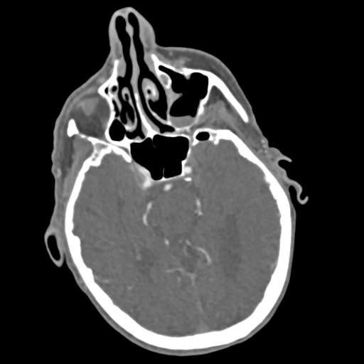 File:C2 fracture with vertebral artery dissection (Radiopaedia 37378-39200 A 228).png