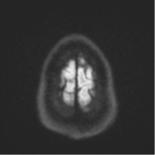 File:CNS vasculitis (Radiopaedia 55715-62263 Axial DWI 57).png