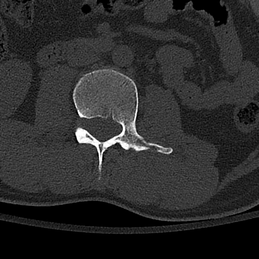 Calcaneal fractures with associated L2 burst fracture (Radiopaedia 71671-82493 Axial bone window 78).jpg