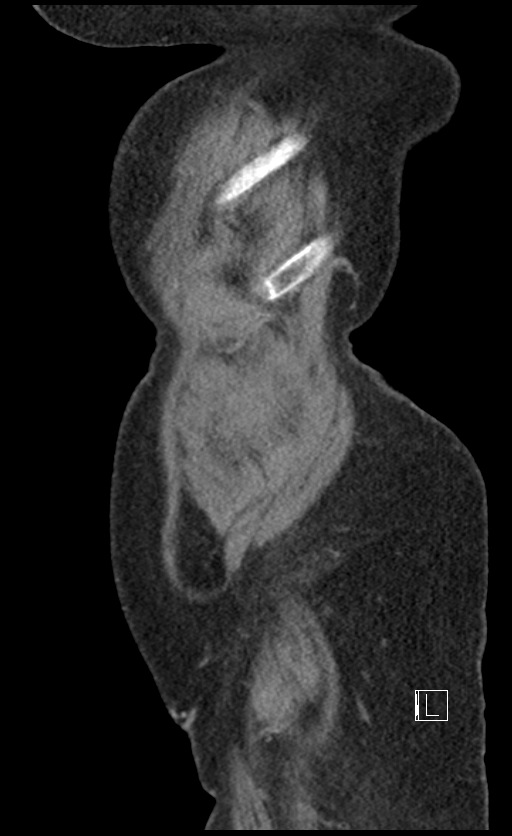 Calcified adrenal glands and Spigelian hernia (Radiopaedia 49741-54988 C 151).jpg