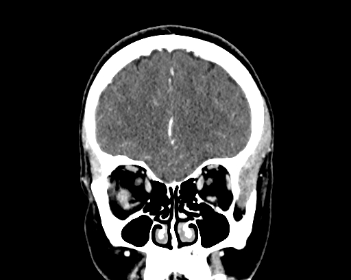 Calcified cerebral hydatid cyst (Radiopaedia 65603-74717 C 14).jpg