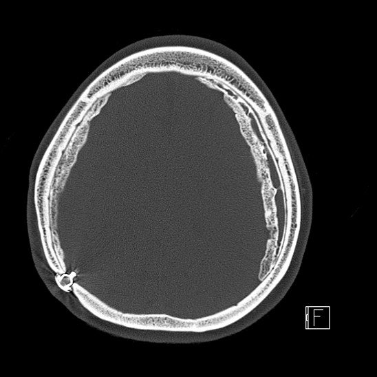 Calcified chronic subdural hematoma (Radiopaedia 77374-89492 Axial bone window 98).jpg