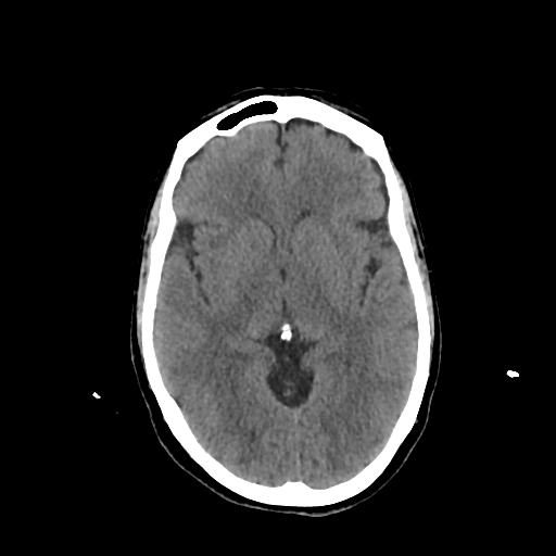 File:Calcified meningioma - cervical canal (Radiopaedia 70136-80171 Axial non-contrast 13).jpg