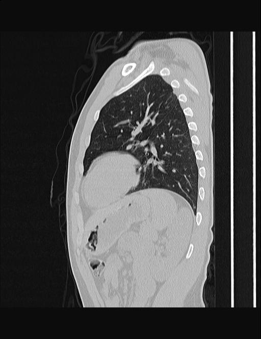 Calcifying pulmonary metastases (Radiopaedia 33359-34396 Sagittal lung window 20).jpg