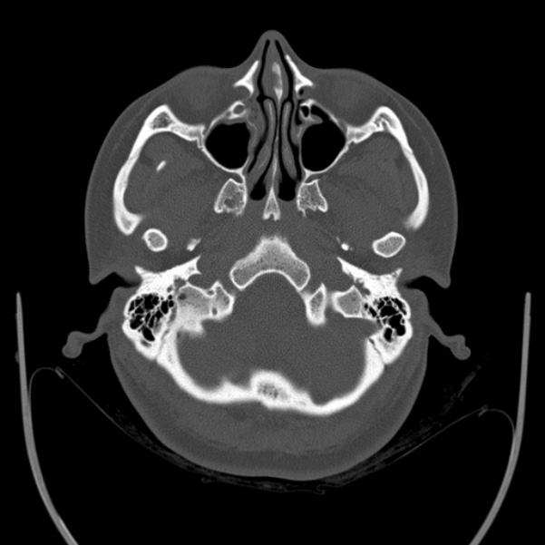 Calvarial osteoma (Radiopaedia 36520-38079 Axial bone window 17).jpg