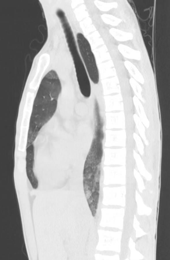 Cannabis-induced diffuse alveolar hemorrhage (Radiopaedia 89834-106946 Sagittal lung window 66).jpg
