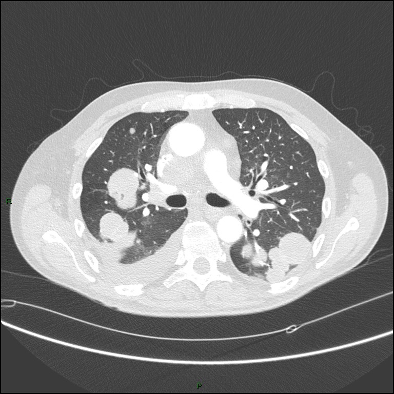 Cannonball metastases (Radiopaedia 82110-96150 Axial lung window 87).jpg