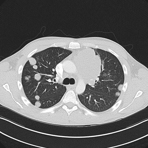 File:Cannonball metastases - testicular choriocarcinoma (Radiopaedia 84510-99891 Axial lung window 38).jpg
