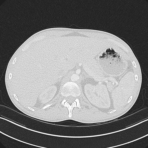 File:Cannonball metastases - testicular choriocarcinoma (Radiopaedia 84510-99891 Axial lung window 95).jpg