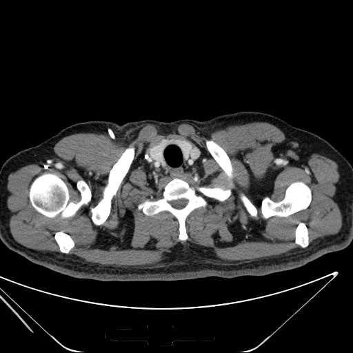 File:Cannonball pulmonary metastases (Radiopaedia 67684-77101 D 8).jpg