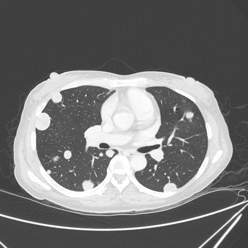 Canonball lung metastasis (Radiopaedia 77634-89837 Axial lung window 85).jpg