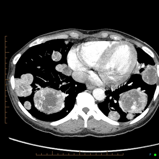 Canonball lung metastasis (Radiopaedia 77634-89837 B 74).jpg
