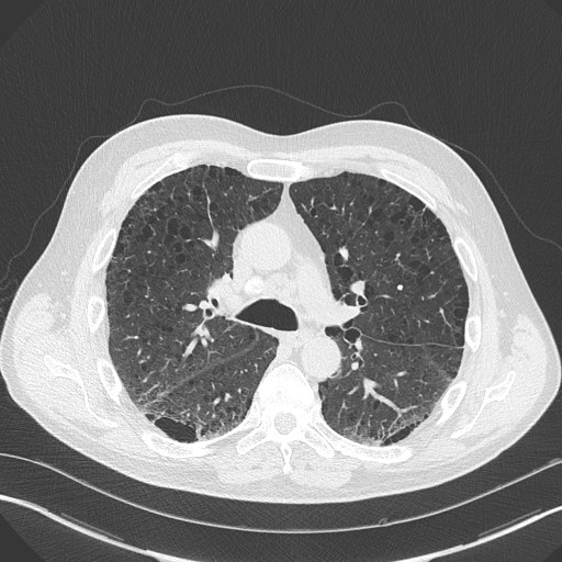 Caplan syndrome (Radiopaedia 56667-63530 Axial lung window 84).jpg