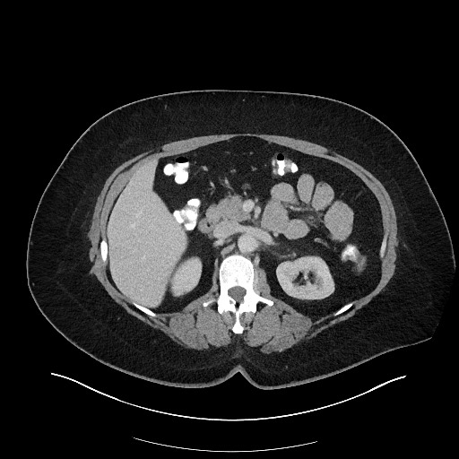 File:Carcinoid tumor - terminal ileum (Radiopaedia 60931-68739 A 48).jpg