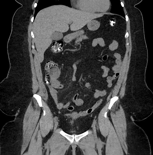Carcinoid tumor - terminal ileum (Radiopaedia 60931-68740 Coronal non-contrast 34).jpg