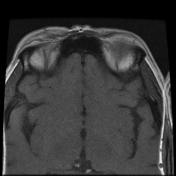 File:Carcinoid tumor of the ileum with metastasis to orbit (Radiopaedia 28165-28424 Axial T1 8).jpg
