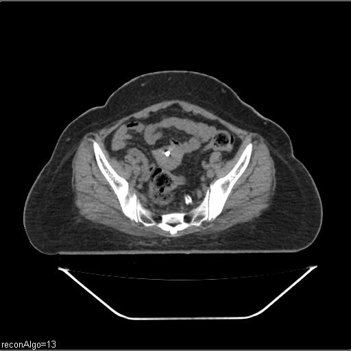 File:Carcinoma cervix- brachytherapy applicator (Radiopaedia 33135-34173 Axial non-contrast 17).jpg