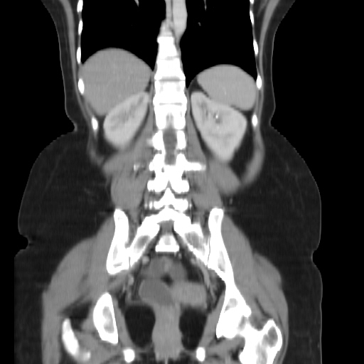 File:Carcinoma colon - hepatic flexure (Radiopaedia 19461-19493 B 29).jpg
