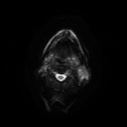 Carcinoma ex-pleomorphic adenoma of parotid (Radiopaedia 28383-28627 Ax DWI B-500 GE 11).jpg