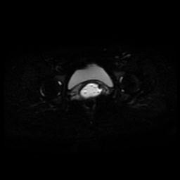 Carcinoma of the cervix (Radiopaedia 89018-105858 Axial DWI 11).jpg