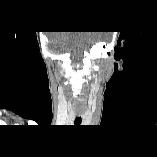 Carcinoma of the maxillary antrum (Radiopaedia 53805-59888 Coronal C+ delayed 108).jpg