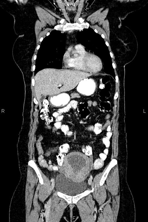 Carcinoma of uterine cervix (Radiopaedia 85861-101700 C 15).jpg
