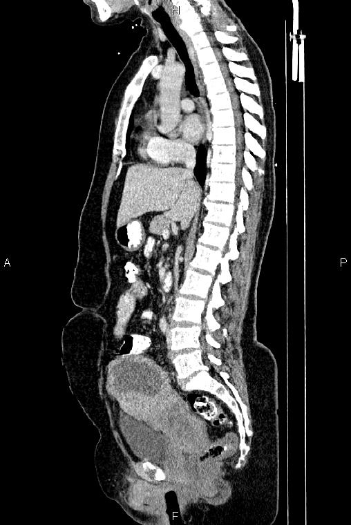Carcinoma of uterine cervix (Radiopaedia 85861-101700 D 40).jpg