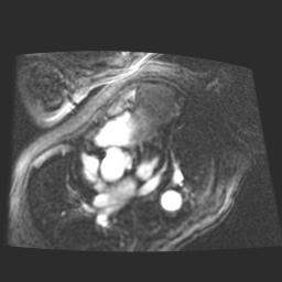 File:Cardiac fibroma (Radiopaedia 38974-41150 4 chamber FGRET 6).jpg