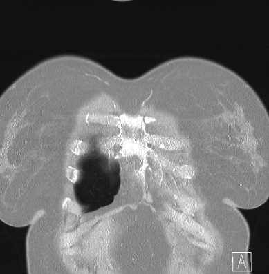 Cardiac sarcoidosis (Radiopaedia 74548-85534 Coronal lung window 3).jpg