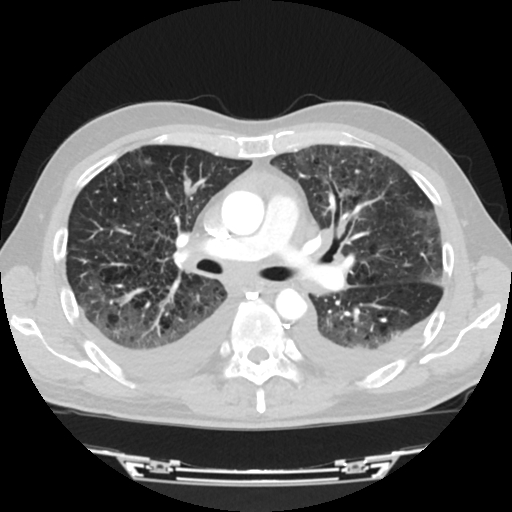File:Cardiac tamponade (Radiopaedia 78607-91368 Axial lung window 35).jpg