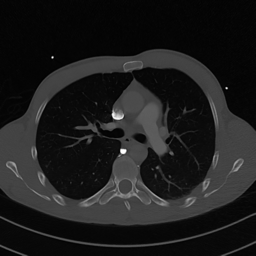 Cardiac tumor - undifferentiated pleomorphic sarcoma (Radiopaedia 45844-50134 Axial bone window 28).png