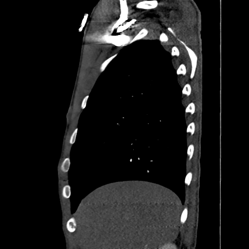 Cardiac tumor - undifferentiated pleomorphic sarcoma (Radiopaedia 45844-50134 B 71).png