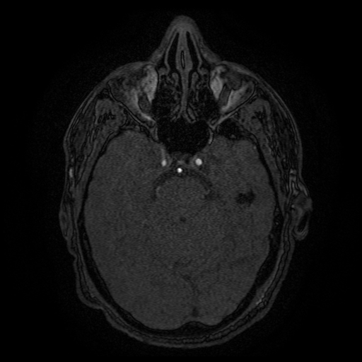 Carotid arterial dissection with acute cerebral infarction (Radiopaedia 26636-26784 MRA 115).jpg
