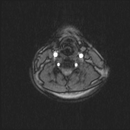 Carotid artery dissection (Radiopaedia 28441-28689 Axial MRA 35).jpg