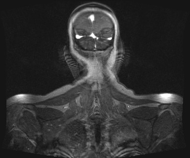 Carotid body tumor (Radiopaedia 12777-12912 MRA 76).jpg