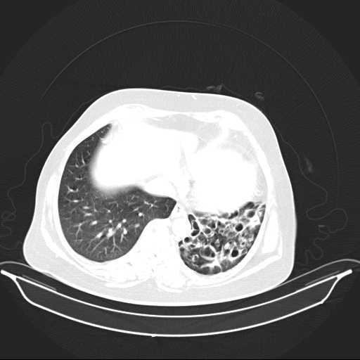 File:Carotid body tumor (Radiopaedia 21021-20948 Axial lung window 33).jpg