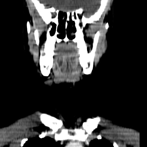 File:Carotid body tumor (Radiopaedia 27890-28124 B 17).jpg
