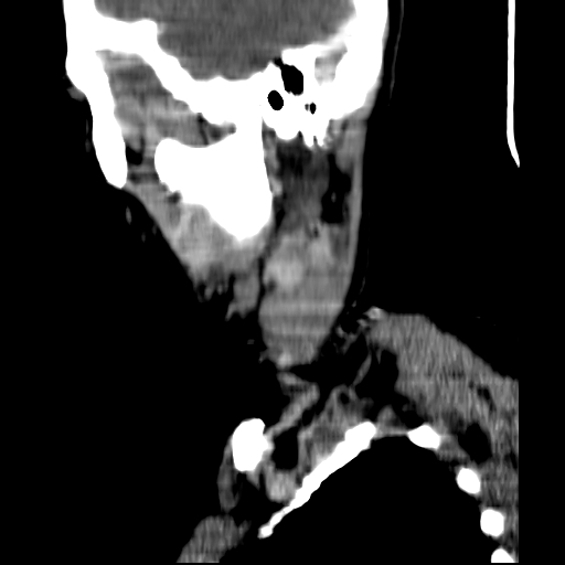 File:Carotid body tumor (Radiopaedia 27890-28124 C 23).jpg