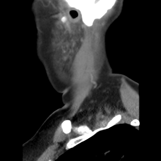 File:Carotid body tumor (paraganglioma) (Radiopaedia 38586-40729 C 25).jpg
