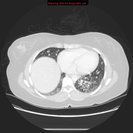Carotid body tumor with lung metastases (Radiopaedia 9301-48390 Axial lung window 47).jpg