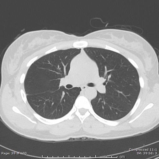 Catamenial pneumothorax (Radiopaedia 54382-60600 Axial non-contrast 39).jpg