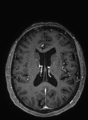 Cavernous hemangioma of the cerebellar falx (Radiopaedia 73025-83724 Axial T1 C+ 139).jpg