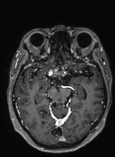 Cavernous hemangioma of the cerebellar falx (Radiopaedia 73025-83724 Axial T1 C+ 202).jpg