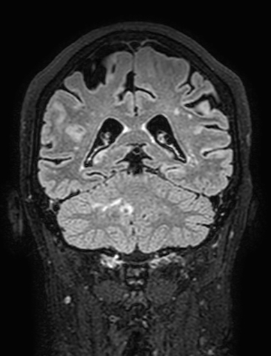 Cavernous hemangioma of the cerebellar falx (Radiopaedia 73025-83724 Coronal FLAIR 239).jpg