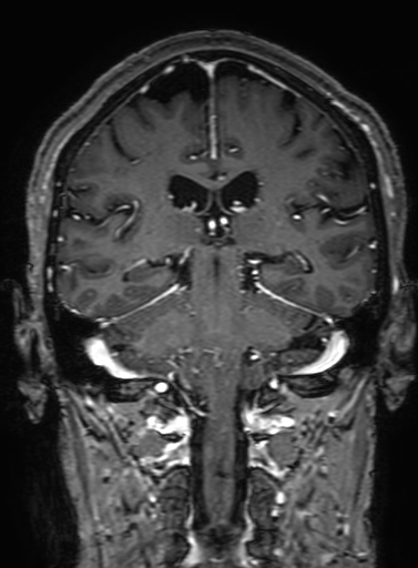 Cavernous hemangioma of the cerebellar falx (Radiopaedia 73025-83724 Coronal T1 C+ 230).jpg
