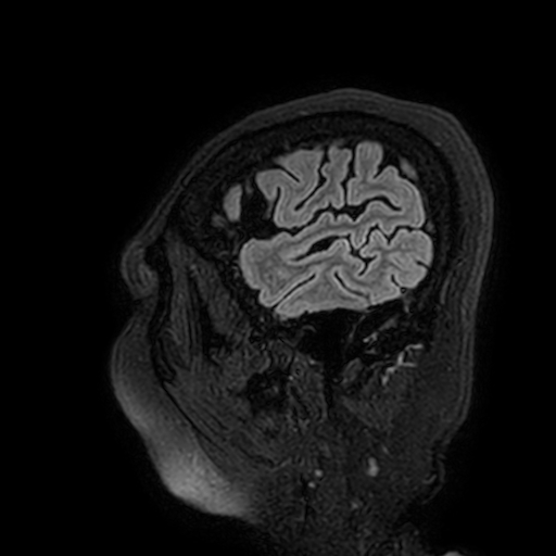 Cavernous hemangioma of the cerebellar falx (Radiopaedia 73025-83724 Sagittal FLAIR 17).jpg
