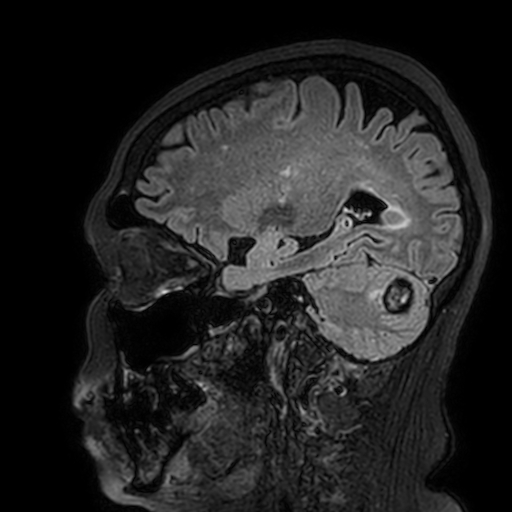 Cavernous hemangioma of the cerebellar falx (Radiopaedia 73025-83724 Sagittal FLAIR 66).jpg