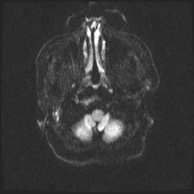 Cavernous sinus meningioma (Radiopaedia 63682-72367 DWI 23).jpg